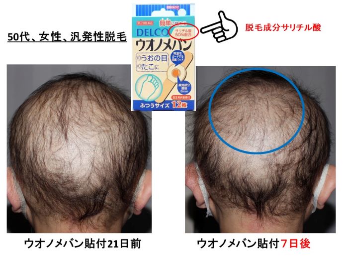 円形脱毛症　病院